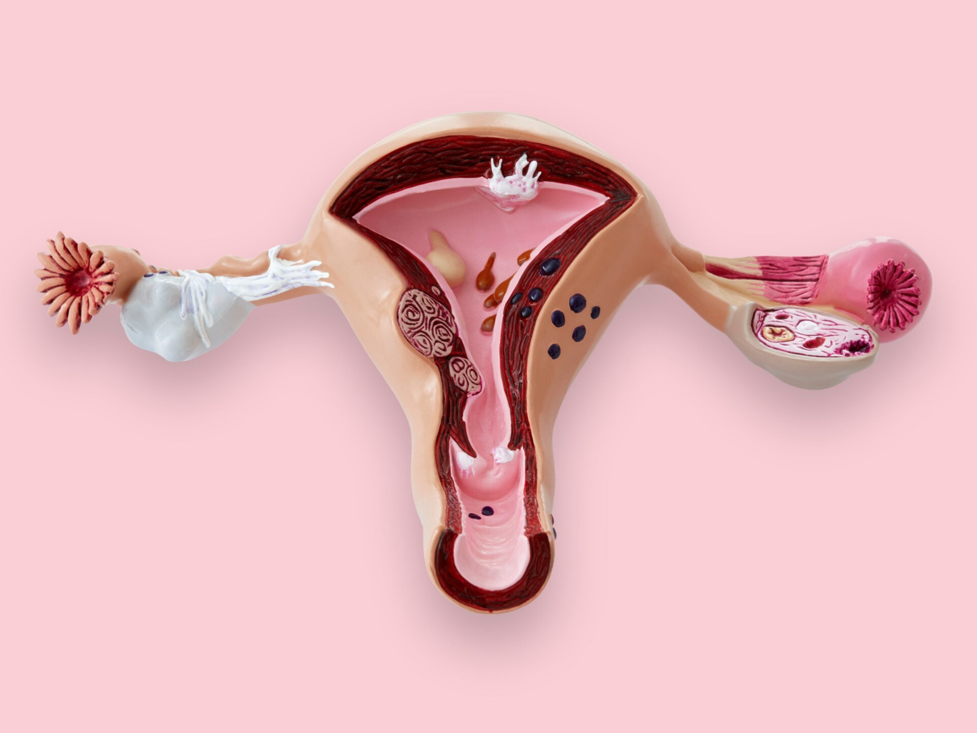 Endometriose en wat kun je eraan doen